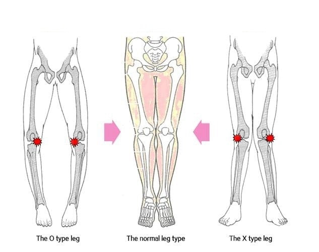 O/X type Knee Straightening Correction Belts - eBabyZoom
